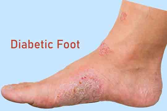 diabetic foot